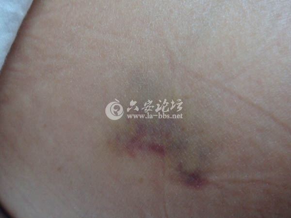 淤青2.JPG