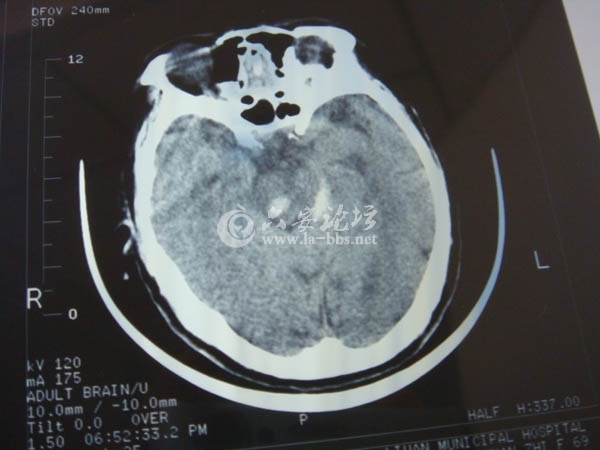 脑部CT2.JPG