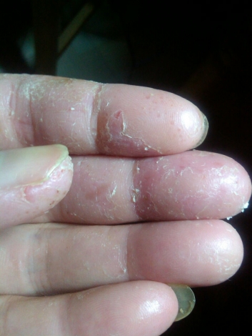 可怕的香虎手，一年多了还是这样。